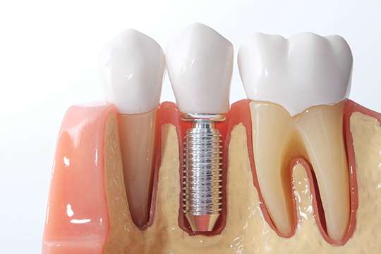implantology dentistry